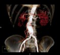 /album/fotogaleria/aneurismo-aortico-abdominal-jpg/
